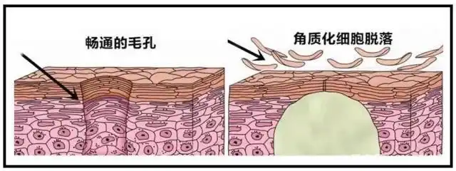 1,物理去角质:靠磨砂颗粒摩擦肌肤,这个原理就牙膏清洁牙齿是一样的.