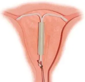 女子上环4年后又意外怀孕是避孕环不靠谱吗