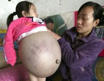 一位山西运城大肚女孩胡云星同样因腹水肿而腹大如球,他的父亲胡先生