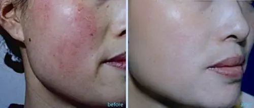 敏感性红血丝,一定要加强防晒! – 时尚女人网