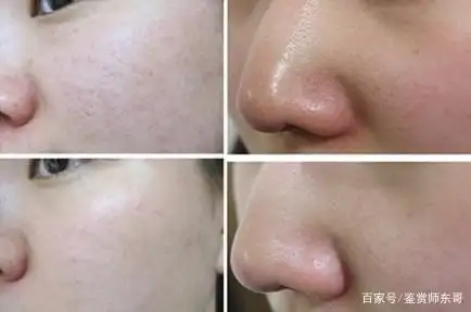 收缩毛孔选择什么医美项目毛孔粗大必看