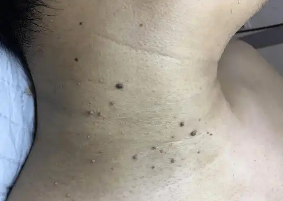 身上长了调皮的"小肉粒",就拿它们这么办!_肿物_治疗_皮肤