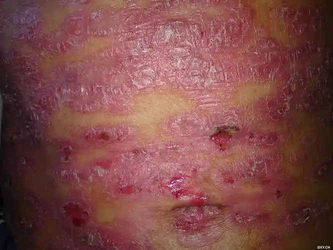 【资料】梅毒图片