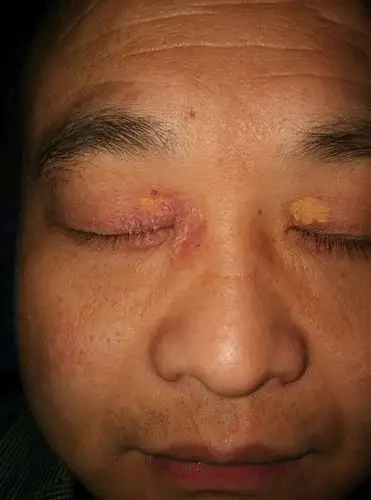眼圈周围痒是神经性皮炎,我发个图片看是不是