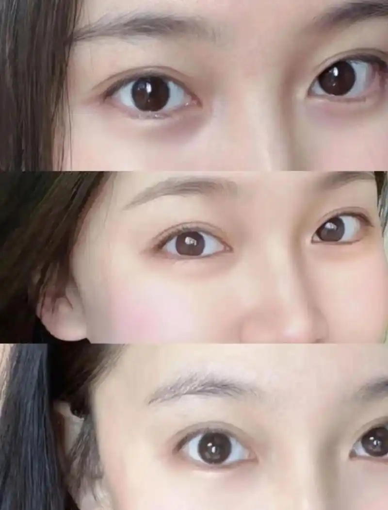 双眼皮98天7815 这简直是我的梦中情眼 平扇依旧自然～ #温州双