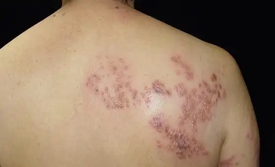 血糖升高的时候,皮肤上会有这些变化,最好了解一下