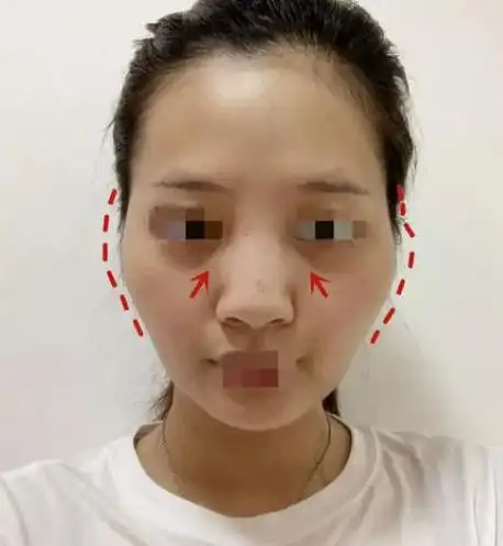 线雕能维持几年小v线多久效果不看不知道啊