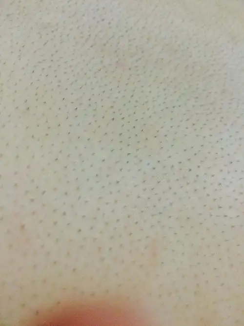 背上毛孔粗大,而且每个毛孔不止长一根毛,毛孔根部还有类似黑头的东西