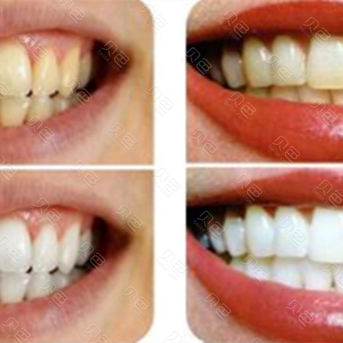 牙齿美白前后对比