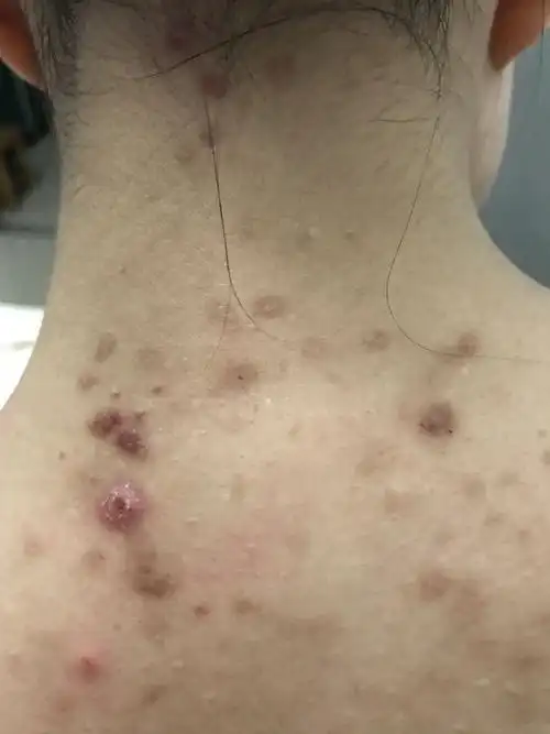 求医后背的痘痘,据说是痤疮,自从有了孩子以后已经困扰我8年了,中途在