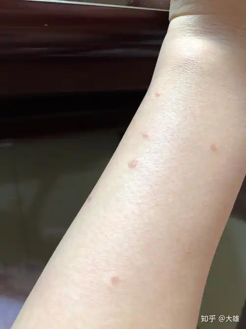 求扁平疣治疗方法