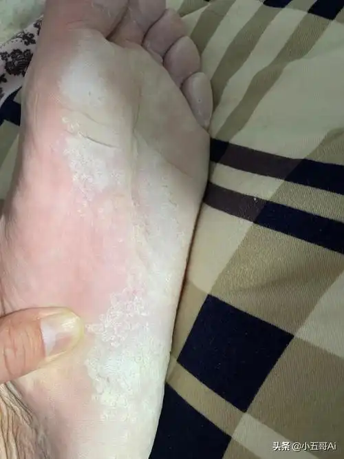 汗脚严重怎么办?脚底出汗?烂脚?用它泡脚,可以消除汗脚