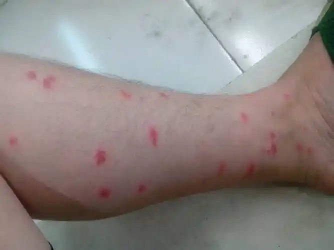 俩小腿一腿包,还很痒,求医看看是皮肤过敏吗