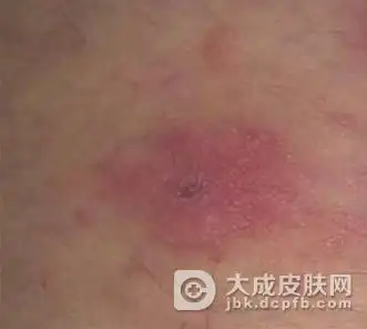 女性一期梅毒具体症状是哪些样的呢