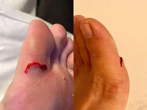 台中女「踢到磁砖」脚掌划开爆血 服务生:贴ok绷