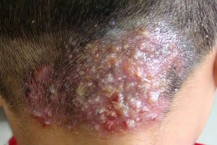 毛囊炎的早期症状图片