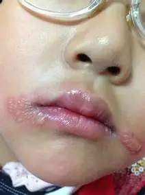 艾滋病初期症状:带状疱疹