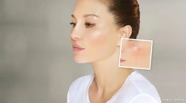 皮肤泛红敏感怎么办 敏感肌肤的修复措施