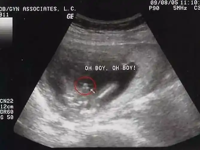 孕4月后如何通过b超来看男女的性别和b超室的暗语