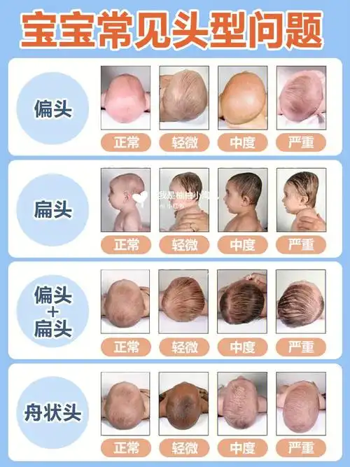 97扁头综合症,是指婴儿头骨后位或侧位发生不同程度的扁平畸形,以及