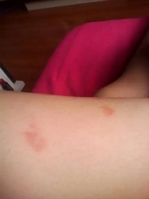 很痒 不像蚊子咬的 还有身上长了很多红点点