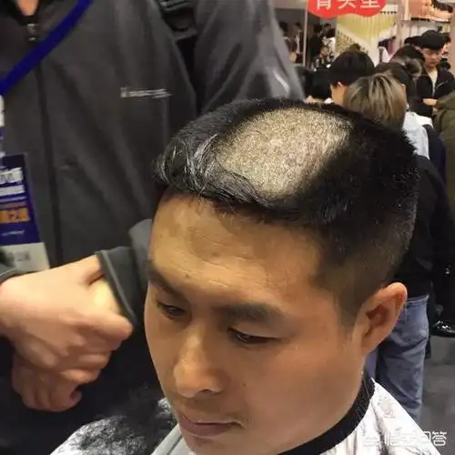 年轻秃头,你选择会带假发吗?,全秃头带假发会掉吗