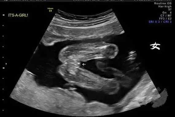 (女宝腿部间性别特征)但四维彩超的主要目的并非是看胎儿性别,当然