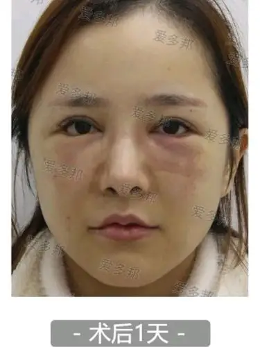 泪沟自体脂肪填充失败修复术后反馈!