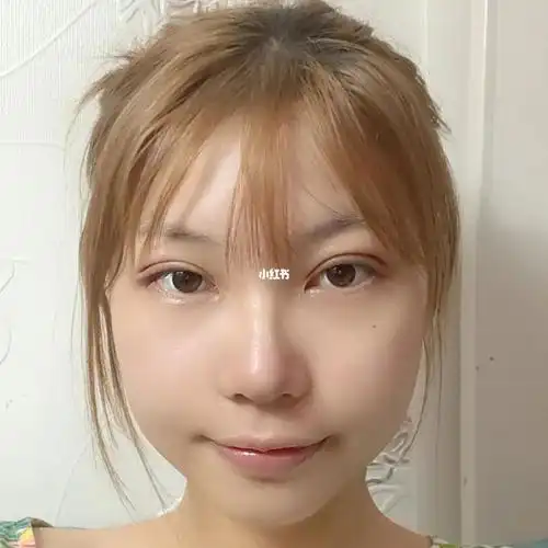 埋线第二天_埋线双眼皮_消肿_美妆_医美整形