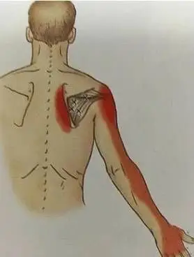 肩胛区疼痛:冈下肌是祸首