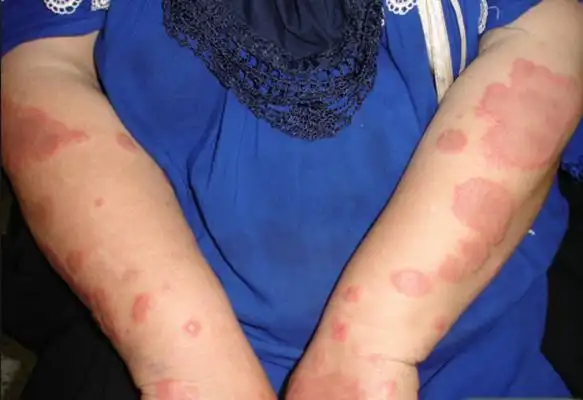 青海玫瑰糠疹医院_青海治疗玫瑰糠疹哪家医院好_青海治疗玫瑰糠疹最好