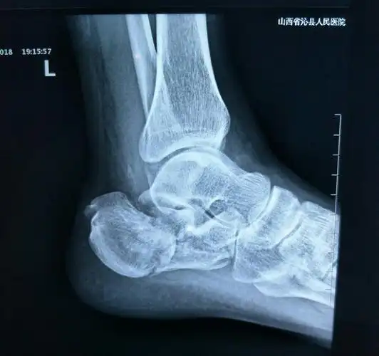 双侧跟骨骨折