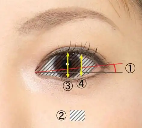 ④为下至术下眼睑下拉的方向,在此方向下拉,使眼睛变大,下眼睑呈优美
