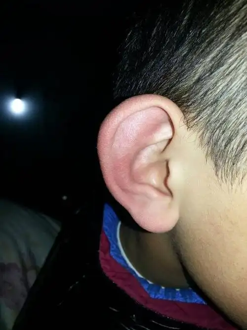 小孩子的耳朵被冻肿了,怎么冶?
