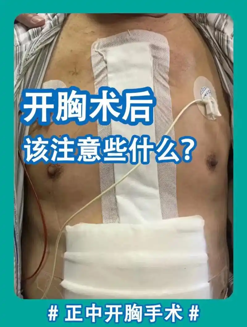 主动咳嗽排痰能帮助尽快康复,选择稳定不下滑的胸带对胸骨形成稳定