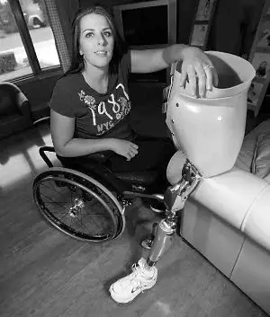 左腿和下腰椎等处都被切除了,装上了左腿义肢和人工骨盆