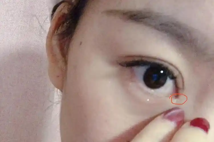 求助姐妹们 眼睛内眼角长了一个小包怎么处理 应该.