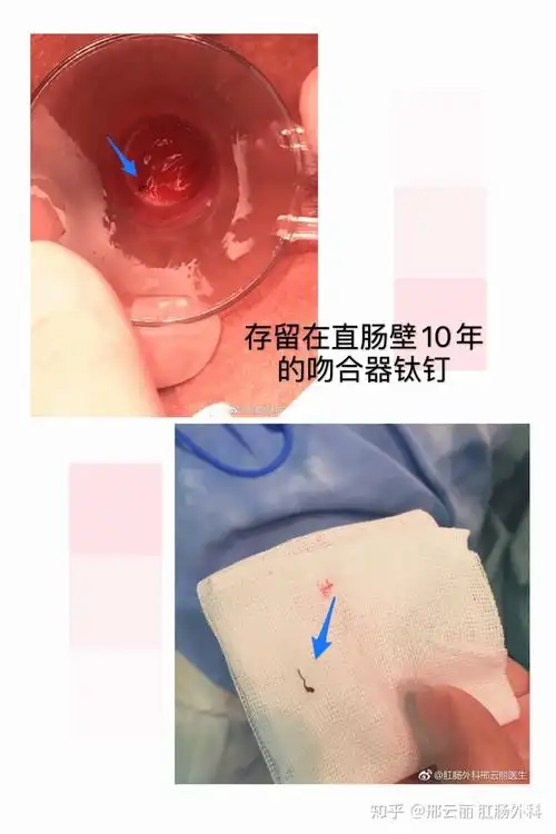 如有确认是吻合钉引起的出血疼痛不适,且确认钉子位置,可以再次手术取