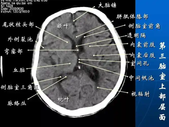 影像总结头颅ct基本知识与常见病变