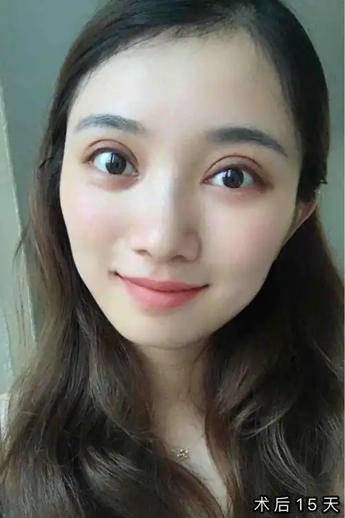 割了双眼皮反而显老怎么回事