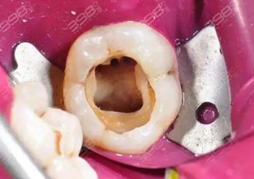 看蛀牙烂到牙神经图片了解牙齿烂洞长期不补会怎样