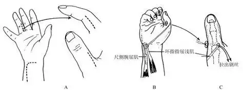 图7 环指指浅屈肌转移重建拇指对掌功能示意(3)拇短屈肌移位重建拇指