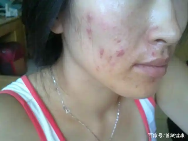 宅家熬夜肌肤修复