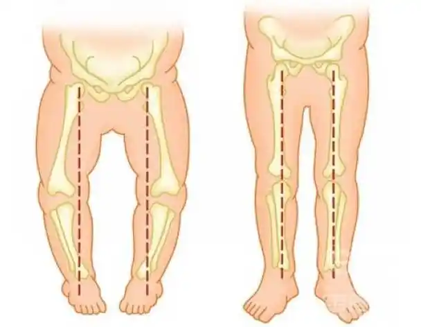 宝宝走路内八字,外八字怎么办,有纠正的方法吗_手机搜狐网