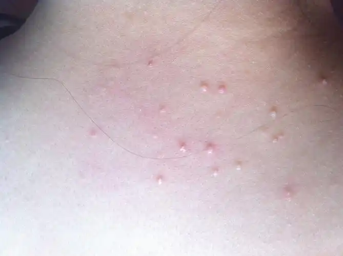 后脖子长了一片小疙瘩?是怎么回事?严重吗?怎么治疗?谢谢解答