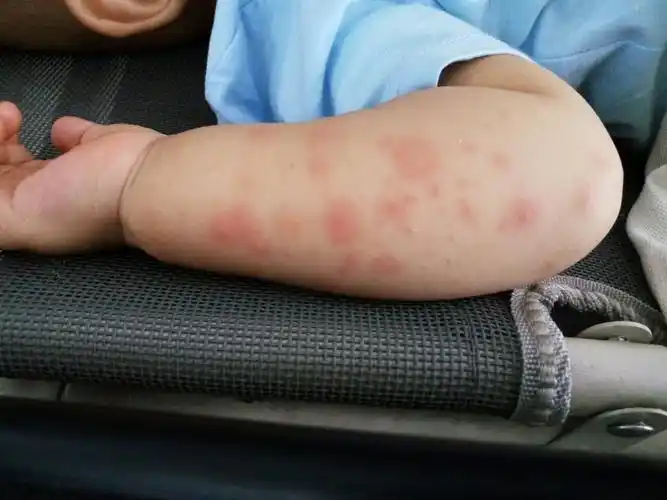 宝宝身上起了好多红疙瘩大块怎么办,孩子九个月了,怎么办?