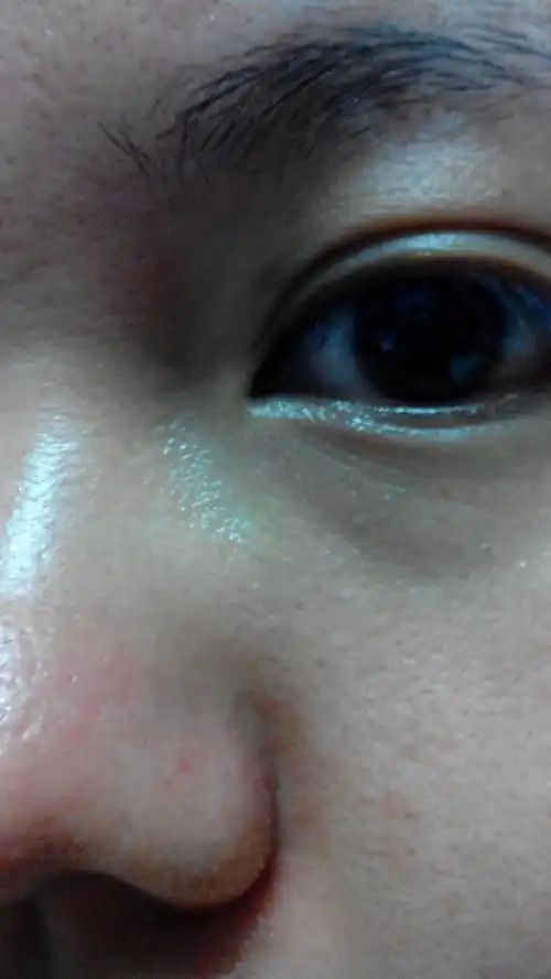 请问这是什么类型的毛孔粗大?是缺水油光型的还是老化型,角质型?