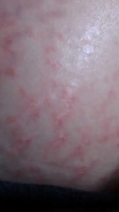 肚皮上长了很多又红又痒的疙瘩,怎么回事?