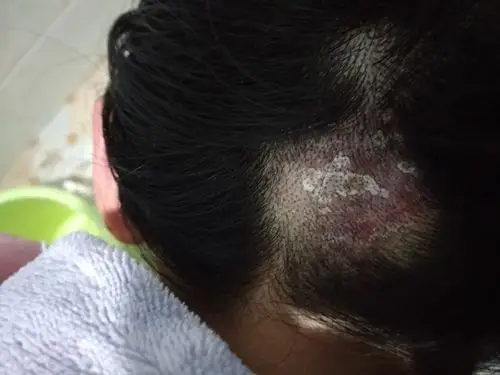 后脑勺瘙痒,起白皮,请老师们指点指点.