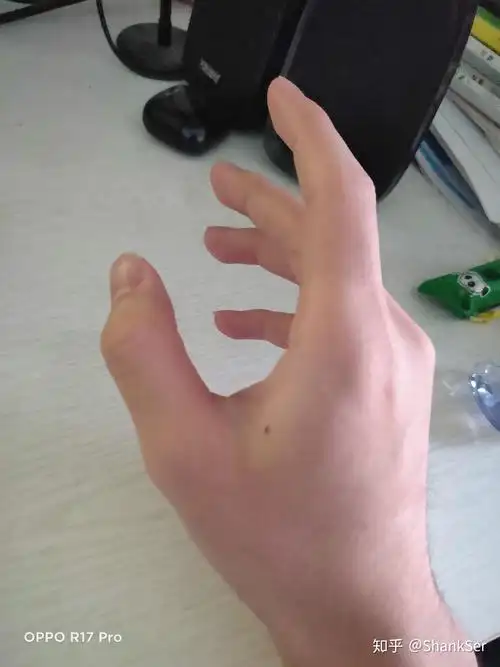 虎口上有痣的人会怎么样